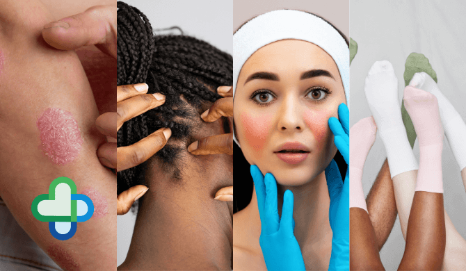 different types of psoriasis